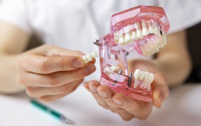 What is Fully Guided Dental Implant Surgery?